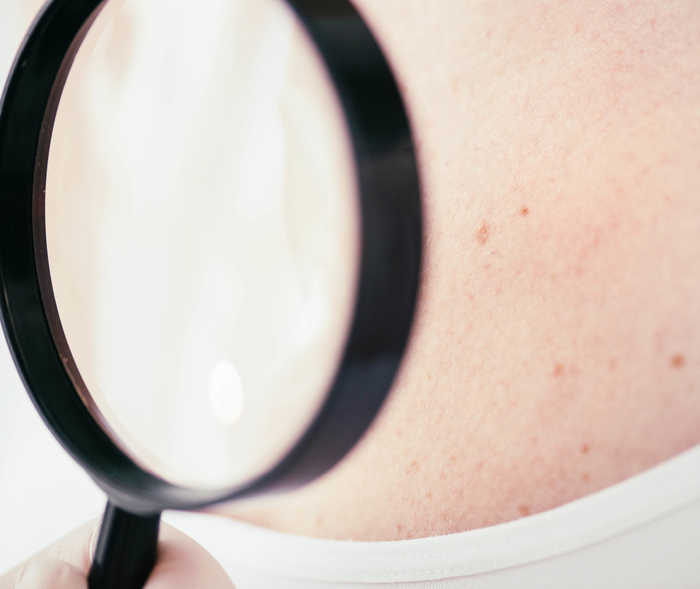 HAUTKREBS & DIAGNOSE