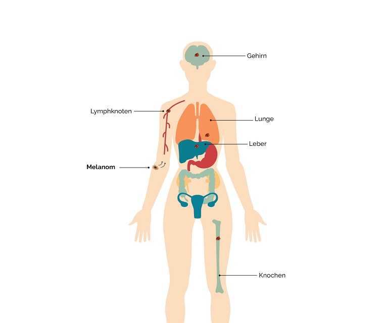 Metastasen, die Ausbreitung der Krebszellen im Körper